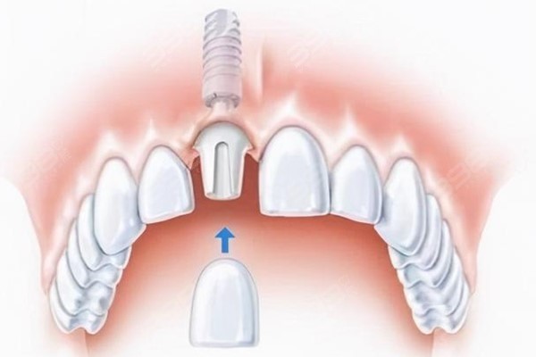 最新镶牙技术，革新牙齿缺损的解决之道