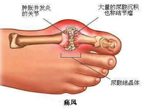 探索前沿科技与医学进步，最新痛风治疗方案